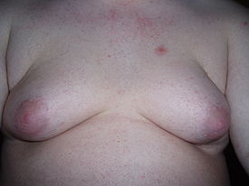 Photo image de la gynécomastie (aussi appelée seins d'homme)